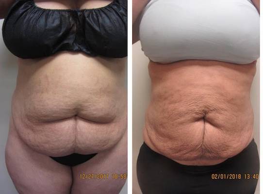 Renuvion/J plasma DRew Varano MD Renuvion/J plasma DRew Varano MD
